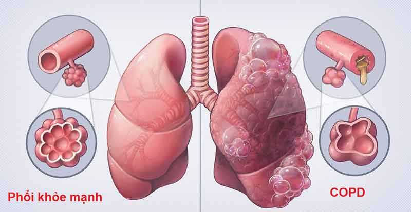 Biến chứng nguy hiểm của phổi tắc nghẽn mãn tính