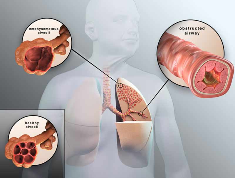 Khó thở là triệu chứng của COPD