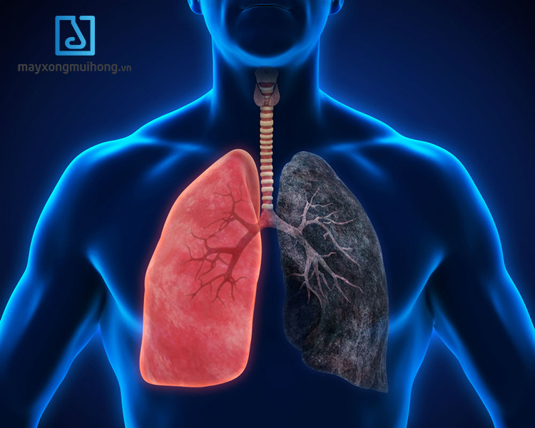 Ung thư phổi là biến chứng nguy hiểm của bệnh xơ phổi