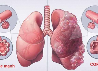 Những biến chứng nguy hiểm của phổi tắc nghẽn mãn tính 