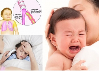 Viêm phế quản ở trẻ em và cách điều trị hiệu quả theo bác sỹ